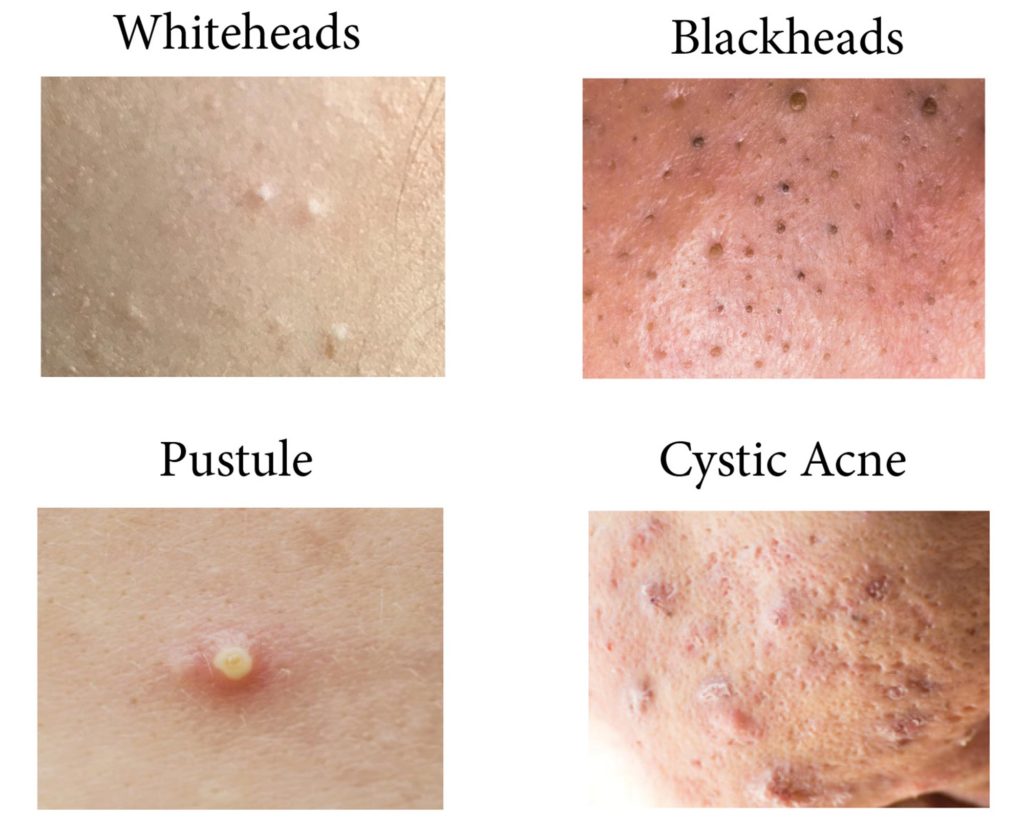 Acne That Just Won’t Go Away? Important Factors To Consider